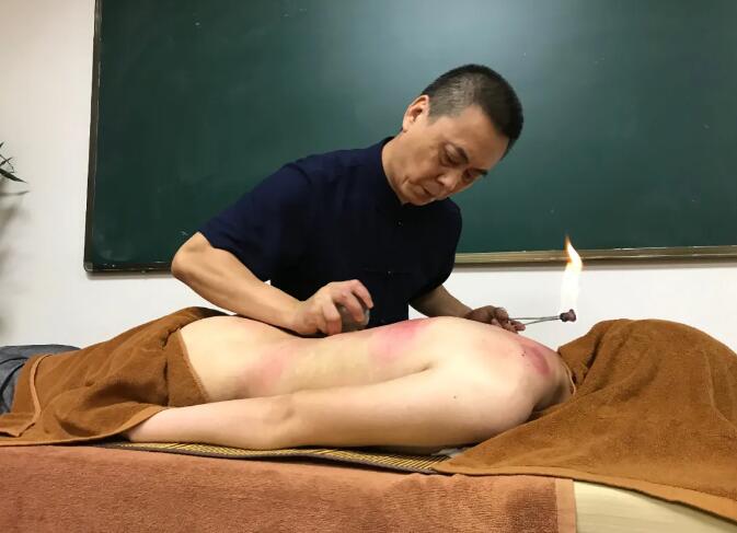 康復(fù)理療培訓(xùn)學(xué)校分享火罐和氣罐的區(qū)別